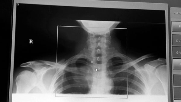 Read more about the article AC Joint Separation